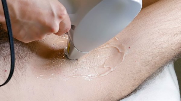 Epilation laser : comment ça fonctionne ?